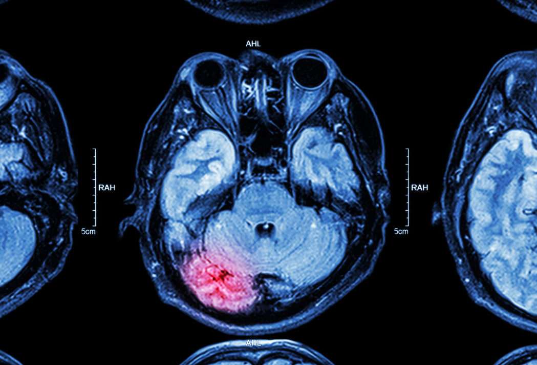 Brain Injury Claims