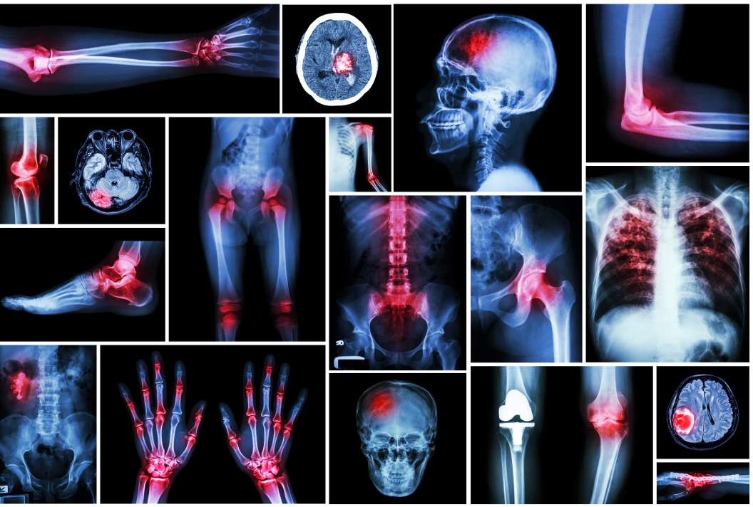 Multiple Injury Claims
